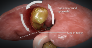 TVA Surg3